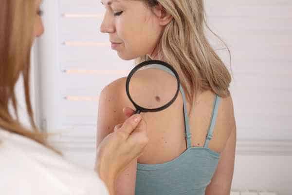 What Are Traditional Skin Lesion Removal Methods Staffordshire?