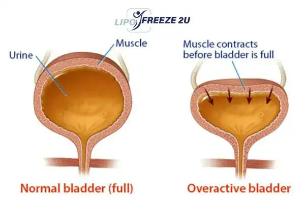 diagram of overactive bladder treatment Staffordshire