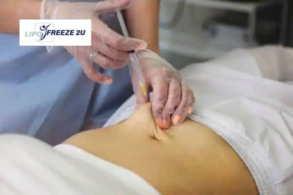 How Does Aqualyx Fat Dissolving Injection Work to Break Down Fat Staffordshire?
