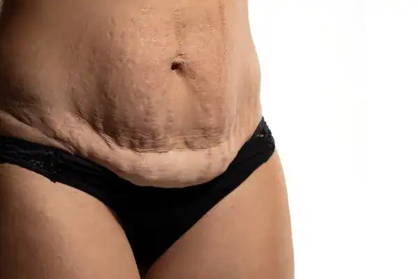 loose skin after weight loss injections Staffordshire