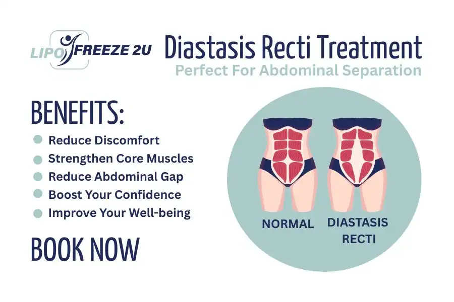 Benefits of body toning treatment Staffordshire for Diastasis recti