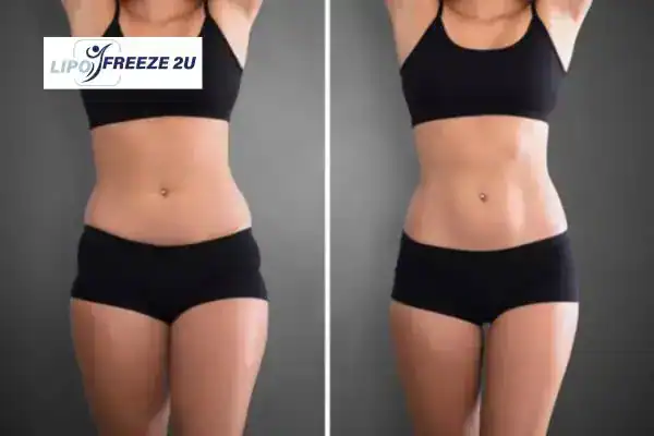 How Can LIPO FREEZE 2U Support Your Post-Pregnancy Body Recovery Staffordshire?