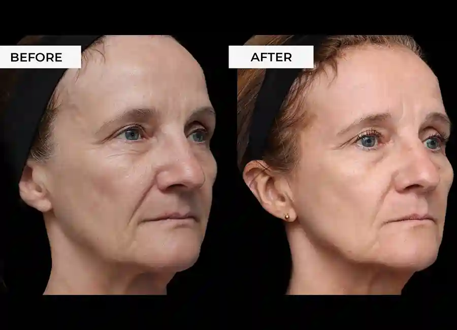 How Many RF Microneedling Sessions Will You Need to See a Difference Staffordshire?