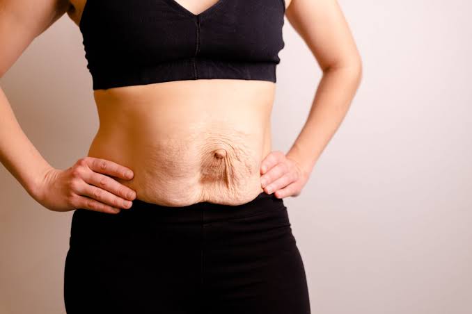 Is Surgery Really the Only Way to Repair Diastasis Recti Staffordshire?